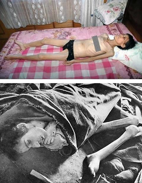 Затворници в китайски лагери. На снимката горе: Сун Шусян, Фалун Гонг практикуваща, след затваряне в лагер. На снимката долу: затворничка в нацисткия лагер Аушвиц.