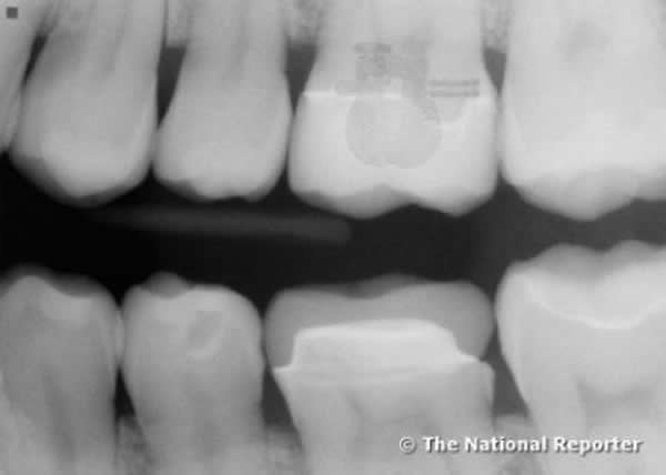 В зъб на полицай от САЩ е намерен извънземен микрочип